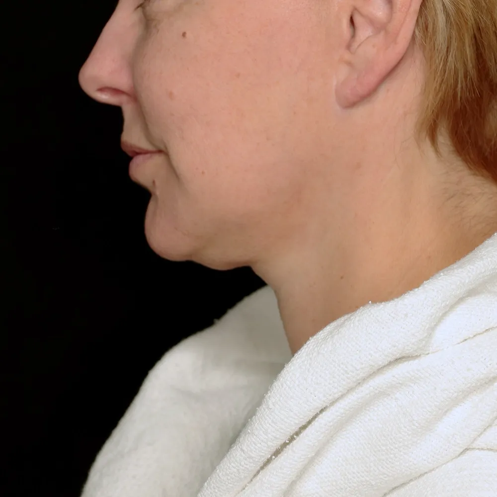 facelift-necklift-01-Lateral