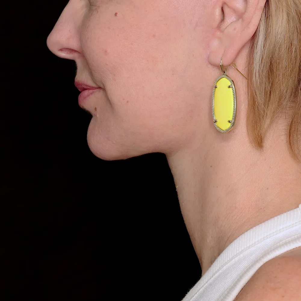 facelift-necklift-02-Lateral