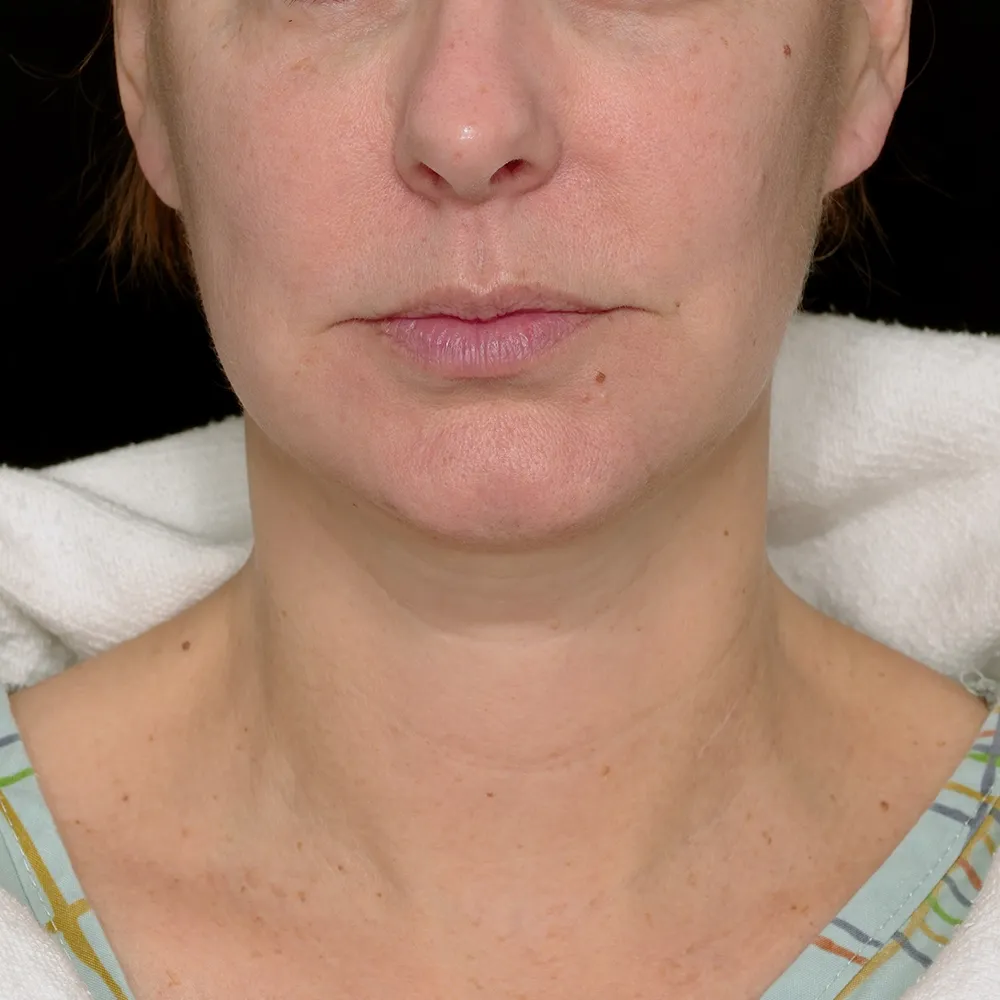 facelift-necklift-03-Lateral