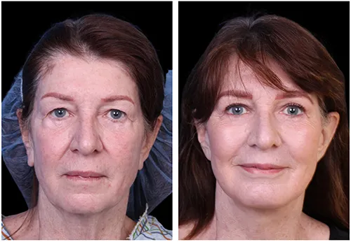 facelift-patient-spotlight