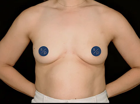Preservé™ Results by Somenek + Pittman MD