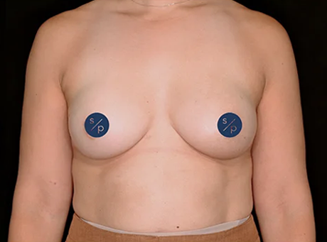 Preservé™ Results by Somenek + Pittman MD