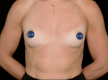 Preservé™ Results by Somenek + Pittman MD