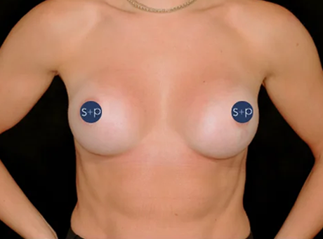 Preservé™ Results by Somenek + Pittman MD