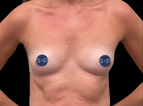 Preservé™ Results by Somenek + Pittman MD