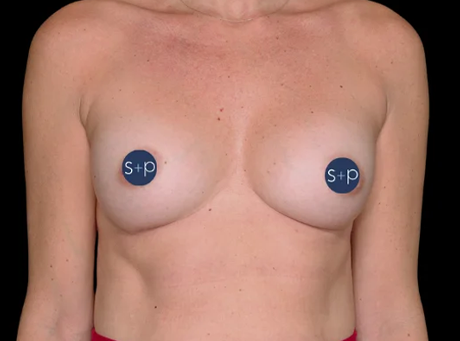 Preservé™ Results by Somenek + Pittman MD